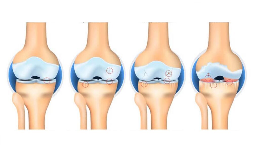 stages of arthropathy of the knee joint