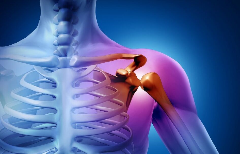 Injury of the shoulder joint due to a joint