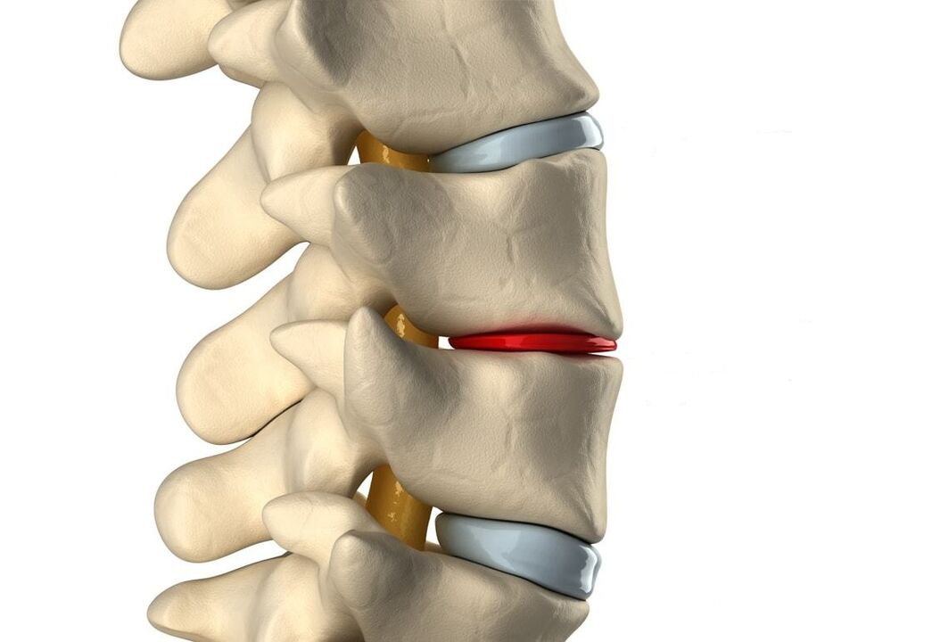 Healthy intervertebral disc (blue) and damaged due to thoracic osteochondrosis (red)