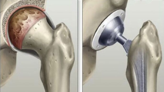 Hip replacement is performed in the final stages of coxarthrosis