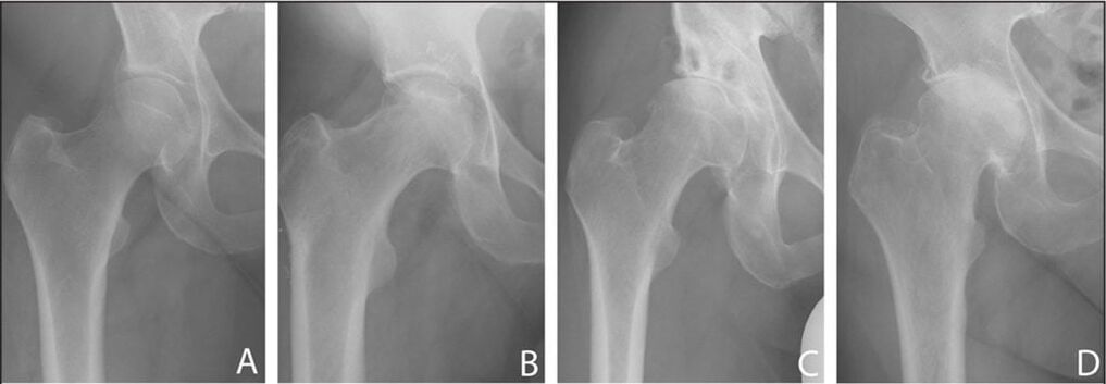 Stages of development of arthropathy of the hip joint on X-ray