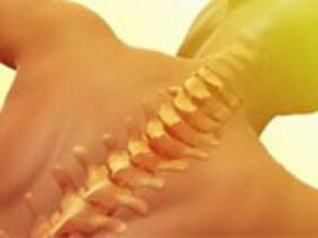 osteochondria - spine disease