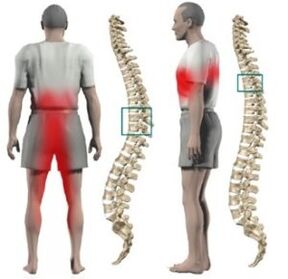 Lumps on the spine