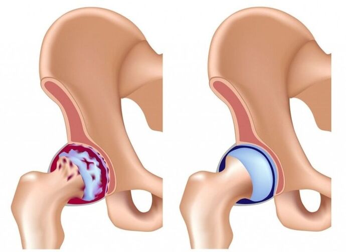 Damage to the hip joint due to arthritis