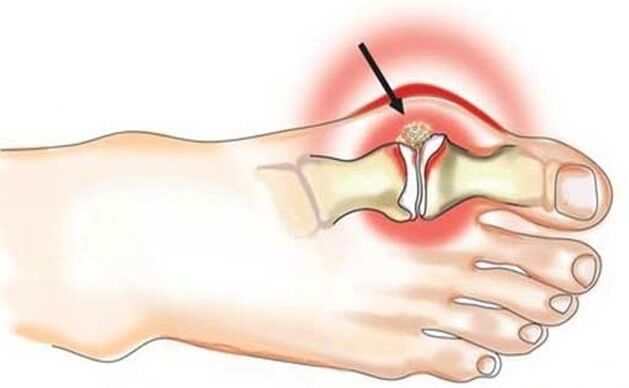 Inflammation of the joint between the big toe and the foot due to arthritis