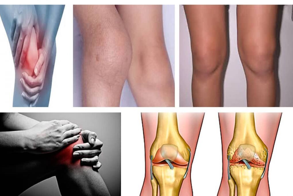 arthritis what is it