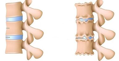 How to recognize the presence of osteochondicity of the lumbar