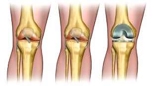 arthroplasty for arthropathy of the knee joint